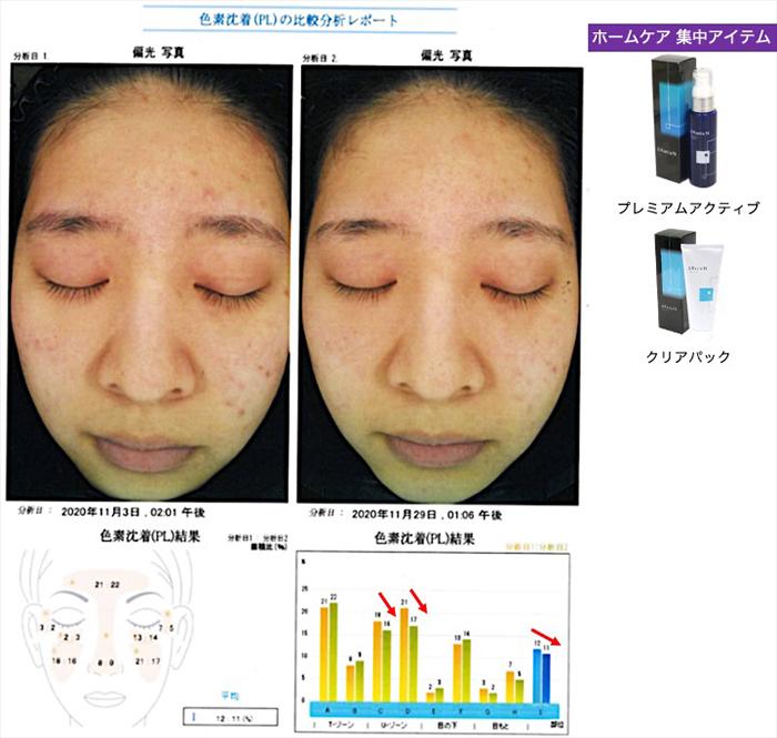 ラティア 1ヶ月ビフォーアフターご紹介